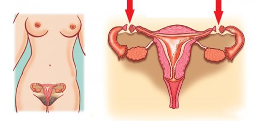 Laqueadura Tubária - Instituto Feminina - Cirurgia ginecológica