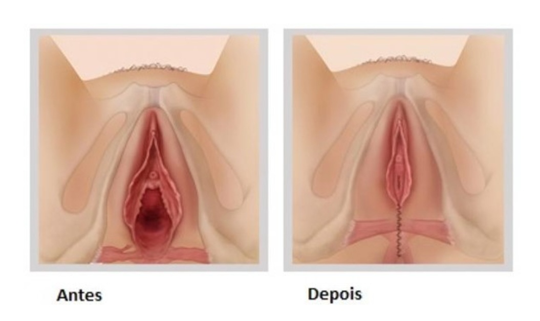 Vagina Larga ou Alargamento de Vagina
